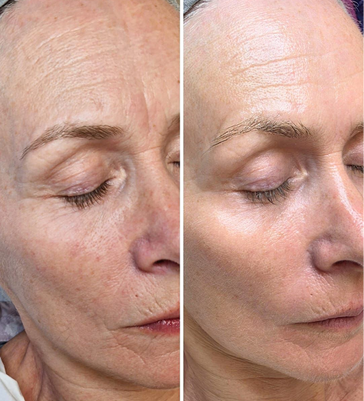 Radiofrekwencja mikroigłowa - skóra po zabiegu w Otwocku